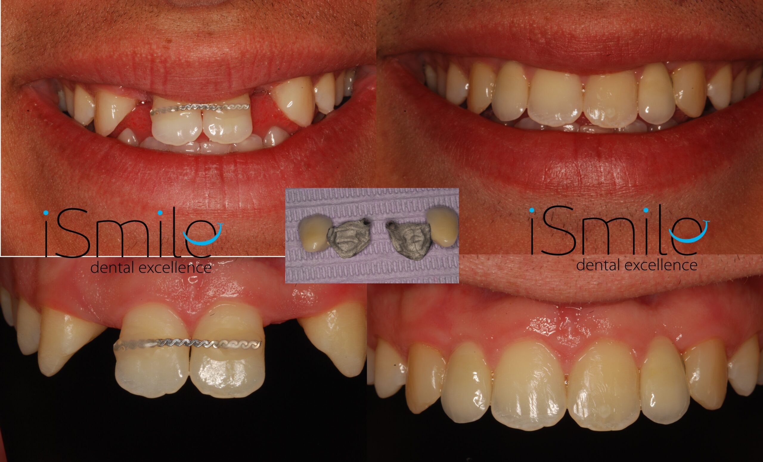 hypodontia before and after